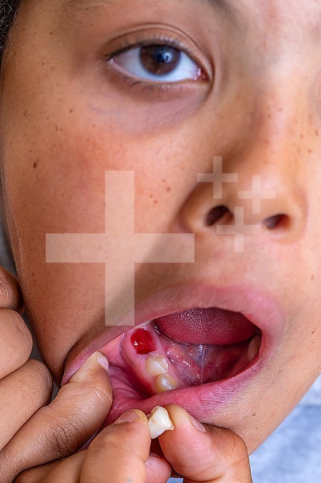 Child opening his mouth with a fallen baby tooth.