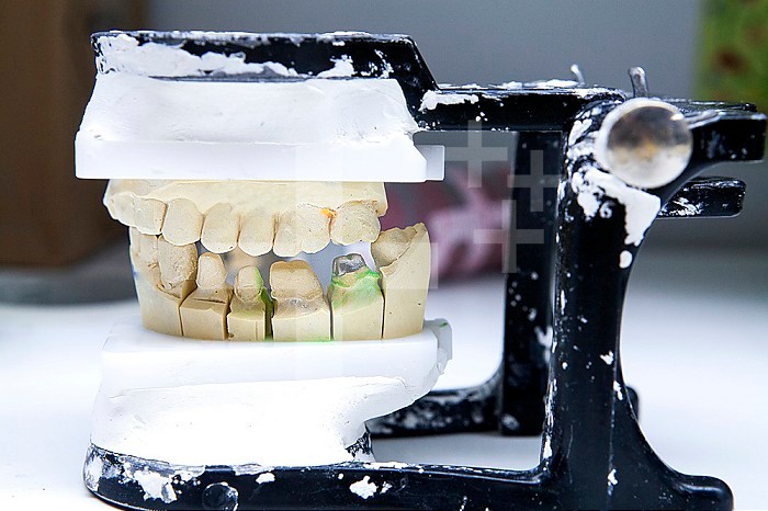 Dental prostheses and Computer Aided Design Manufacturing system from a digital impression.