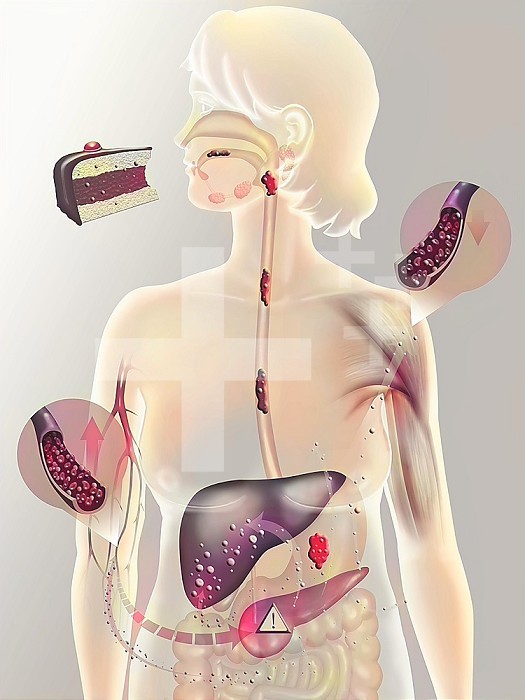 Secretion of insulin on a person with diabetes type 2. Diabetes type 2 (or non-insulin-dependent) is a form of diabetes mellitus affecting mainly adults over 40 due to a food too rich in fat, the metabolism of glucose is very perturbated. The muscle cells do not respond normally to the action of insulin, that is responsible for indicating them to let glucose enter to make glycemia decrease (rate of sugar in the blood). The ingestion of a sweetened aliment causes an increase of glycemia (glucose in blue). This provoks the secretion of insulin (in yellow) by the pancreas, that is sent to different organs of the body to stimulate the use of glucose, mainly towards the muscles and the spleen. Thereby, glucose will be either transformed into glycogen (in green) to be stocked in the liver and the muscles, or either used by the other organs. This will then make the rate of blood sugar decrease. On the patient with diabetes type 2, often in overweight, the secretion of insulin by the pancreas is insufficient to cover the needs , so the rate of blood sugar remains high despite the production of insulin by his pancreas. See. images 8814106 for the metabolism of glucose on a non-diabetic individual, 8813706 for the diabetes type 1 and 8810906 for the diabetes type 2 on a masculine silhouette.