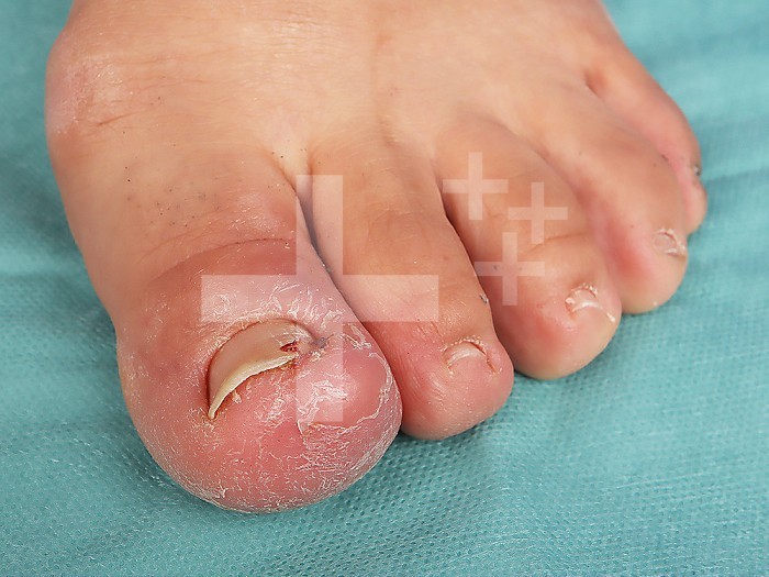 Ingrown toenail of the thumb of the foot in a 45-year-old man.