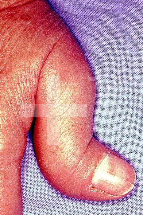 Joint deformities of a thumb caused by rheumatoid arthritis (chronic inflammatory degenerative disease).