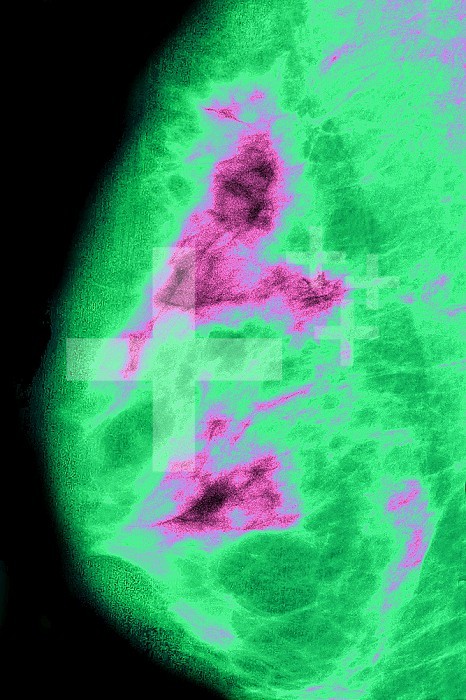 Breast cancer visualized by mammography.
