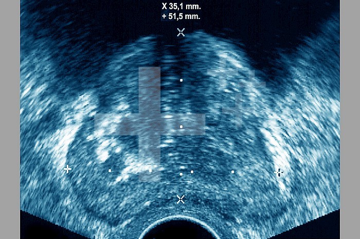 Prostate cancer (adenocarcinoma of the prostate), visualized by ultrasound.