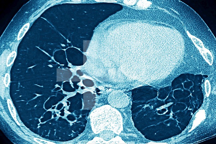MRI of pulmonary cystic fibrosis (viscous mucus disease, cystic fibrosis affecting glandular epithelia). Radial MRI of the lungs.