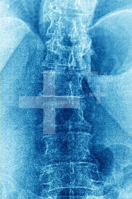 Significant degenerative lumbar disc disease in a 75-year-old woman, frontal x-ray.