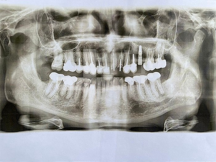 Dental panoramic of a 70 year old man with an implant and many crowns. Paris, Ile-de-France, France.
