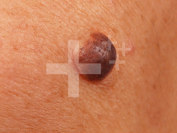 Pure dermal nevocellular nevus of the cheek in a 56-year-old woman.