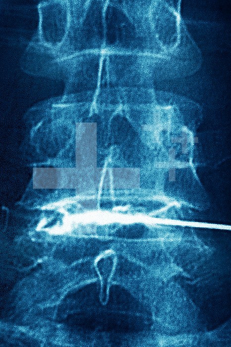 Corticosteroid infiltration between the fourth and fifth lumbar vertebrae, done under radiographic control