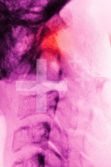 Dislocation between the first and second cervical vertebrae, visualized by a sagittal x-ray of the cervical spine.