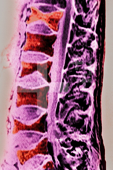 Osteoporosis on lumbar vertebrae. Sagittal MRI of the spine