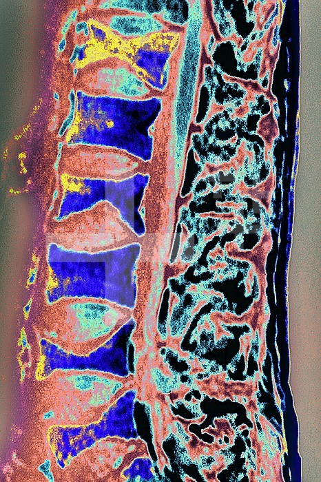Osteoporosis on lumbar vertebrae. Sagittal MRI of the spine