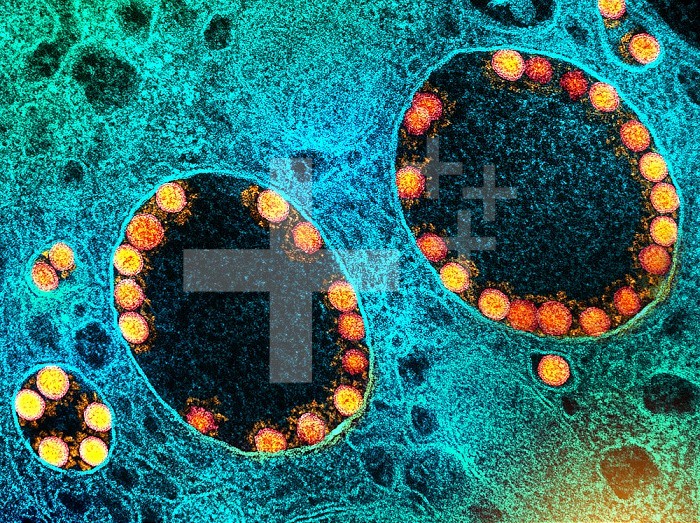 Transmission electron micrograph of SARS-CoV-2 virus particles (gold) within endosomes of a heavily infected nasal Olfactory Epithelial Cell. Image captured at the NIAID Integrated Research Facility (IRF) in Fort Detrick, Maryland.