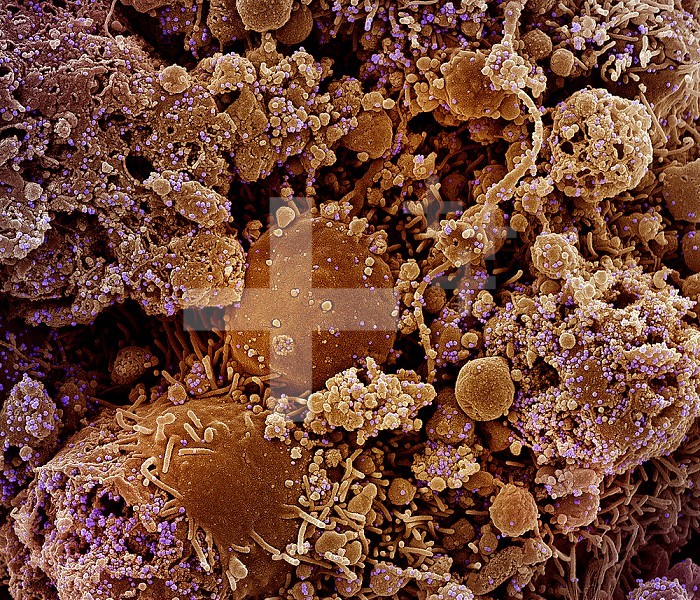 Colorized scanning electron micrograph of chronically infected and partially lysed cells (brown) infected with a variant strain of SARS-CoV-2 virus particles (purple), isolated from a patient sample. Image captured at the NIAID Integrated Research Facility (IRF) in Fort Detrick, Maryland.