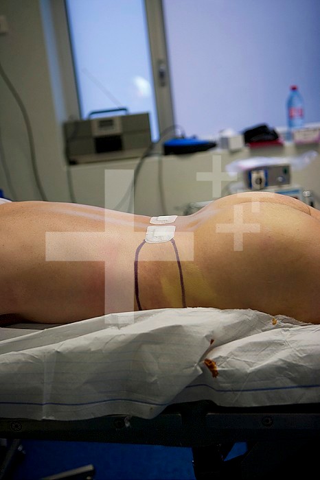 Cosmetic surgery, liposuction, aspiration of fat by a pump.