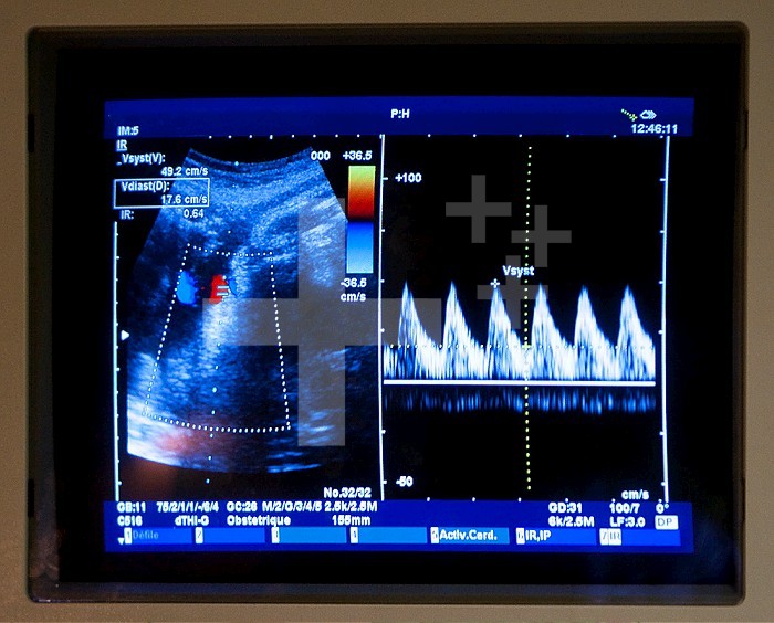 Ultrasound at 8 months of pregnancy in the maternity ward of a hospital.