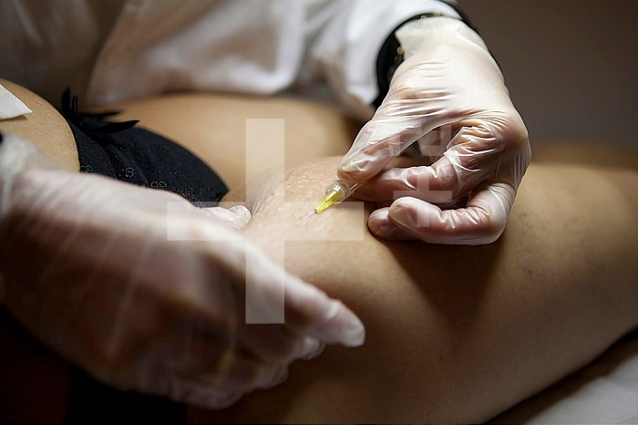 Treatment of cellulite and stretch marks by carboxytherapy, or the subcutaneous injection of carbon dioxide.