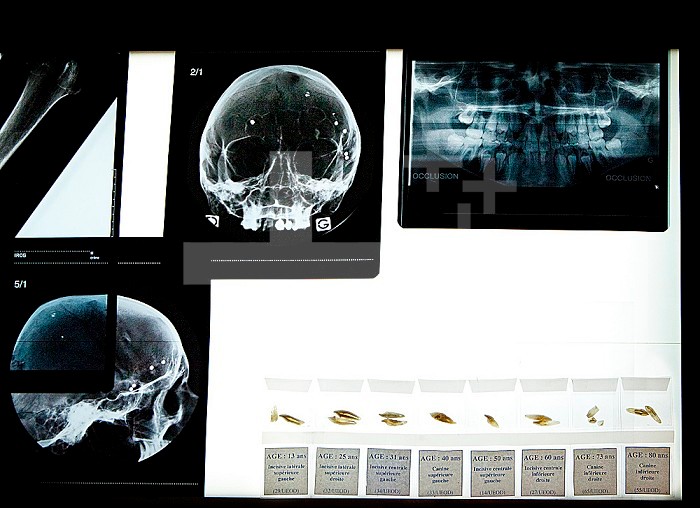 Forensic science and criminal research: x-ray of a skull having been shot several times.