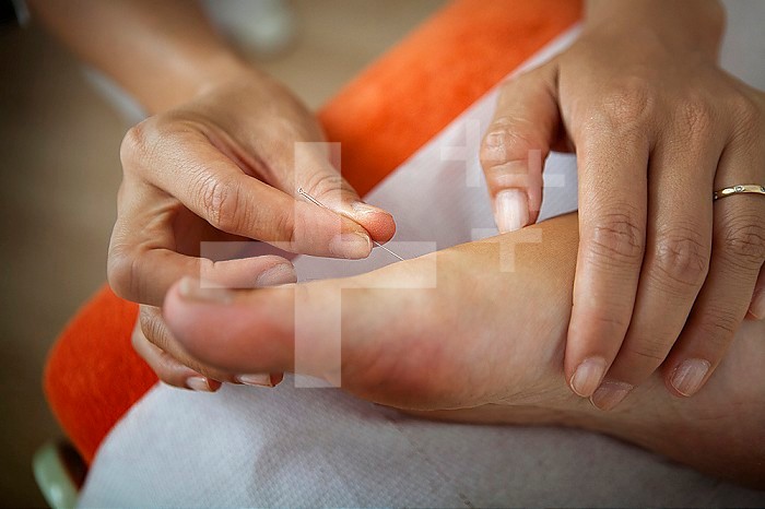 Naturopath putting acupuncture needles on a patient´s foot.