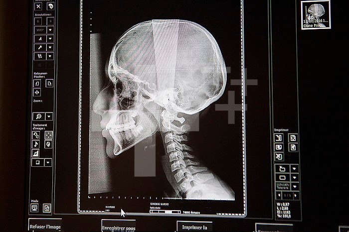 X-ray of the skull of a teenage girl in a radiology center.