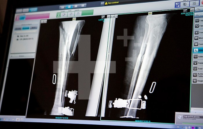 X-ray of the leg of a patient who had a ski fall with a fractured tibia and fibula.