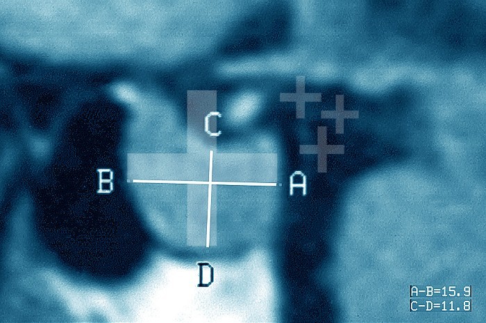 Pituitary adenoma visualized by MRI of the skull, in sagittal section.