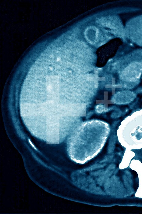 Lymphoma revealed by lymphadenopathy between the liver and the gallbladder. abdominal scan in radial section.