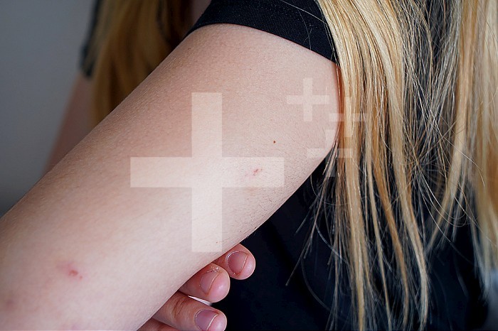 Trace of a needle prick on the arm of a patient, in the emergency room of a university hospital. This young girl was pricked by a needle, without her knowledge, during an evening in a bar and fears an injection of drug. She will be on treatment for four days to prevent possible transmission of HIV.