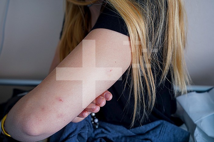 Trace of a needle prick on the arm of a patient, in the emergency room of a university hospital. This young girl was pricked by a needle, without her knowledge, during an evening in a bar and fears an injection of drug. She will be on treatment for four days to prevent possible transmission of HIV.