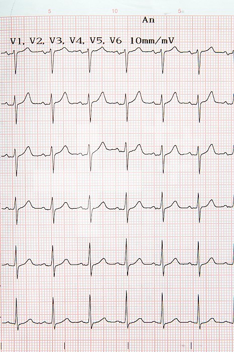 Electrocardiogram, human heart.