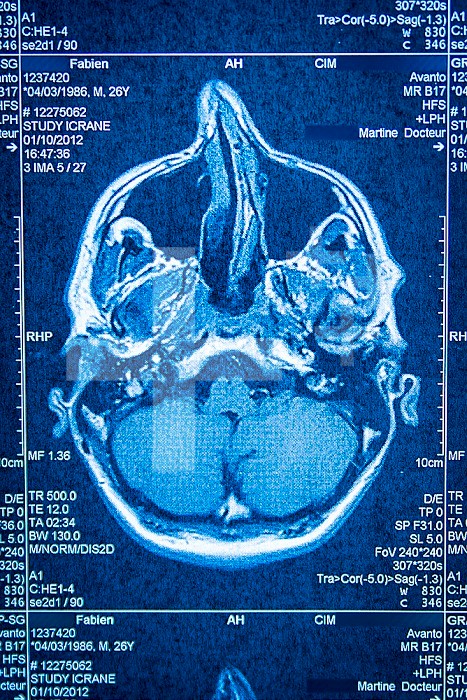 Tomography of the brain obtained by scanner.