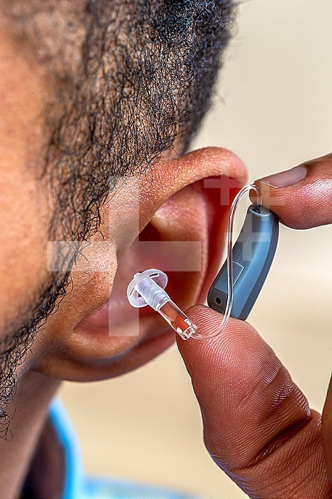 Close-up of the installation of the prosthesis in the ear of a young man.