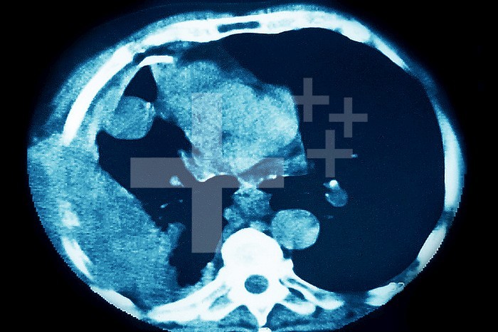 Lung cancer (cancerous tumor consisting of a group of cancerous cells that invade nearby tissues and destroy them, they can also spread in metastases). Lungs visualized by thoracic scanner in radial section.