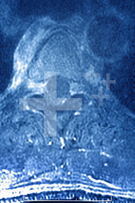 Vertebral osteitis (inflammation of bone tissue in a dorsal vertebra, caused by a bacterial infection). radial x-ray of a dorsal vertebra.