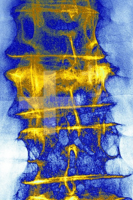 Vertebral osteoporosis (bone disease characterized by a decrease in bone mass, as well as bone deformation by compression and risk of spontaneous fractures.). Lumbar vertebral x-ray.