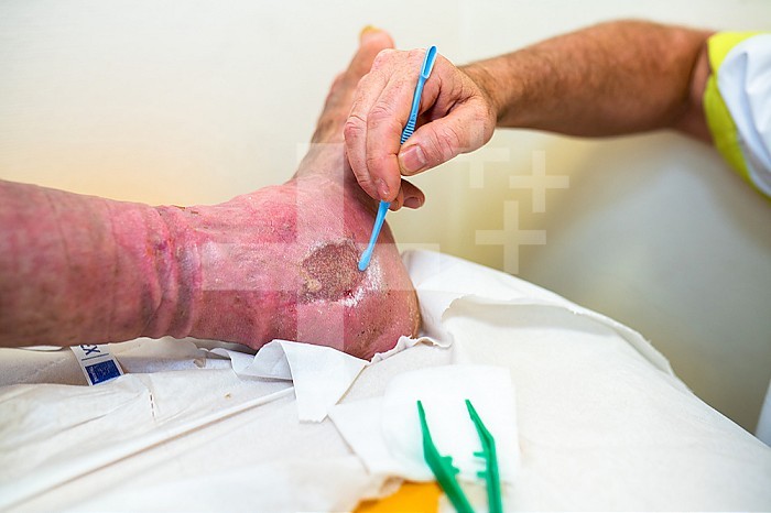 Care of a patient´s foot ulcer. Wound cleaning and dressings.