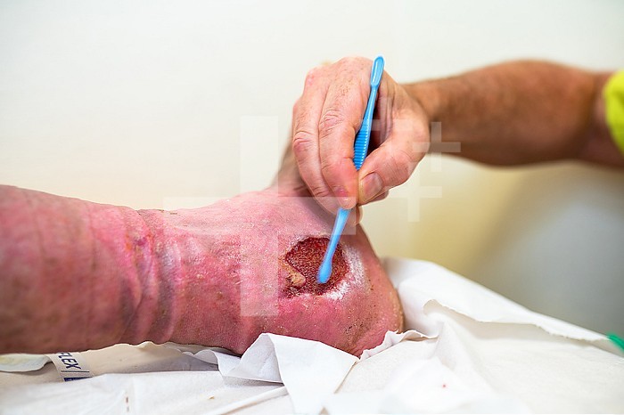 Care of a patient´s foot ulcer. Wound cleaning and dressings.