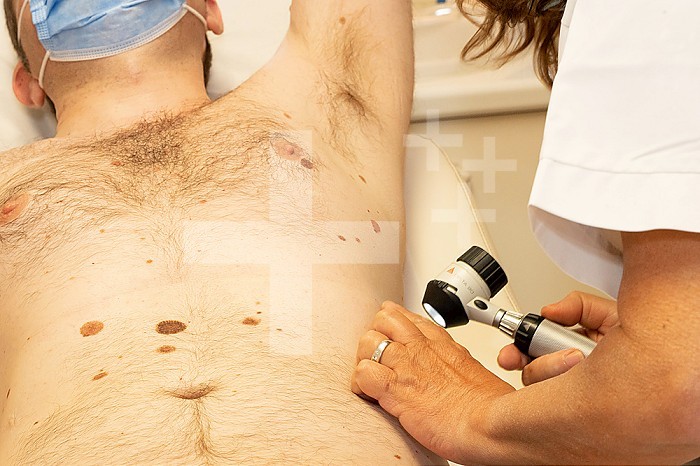 Checking moles on a patient. For the dermatologist, the problem is to distinguish a benign mole from a melanoma, the development of which can be fatal.