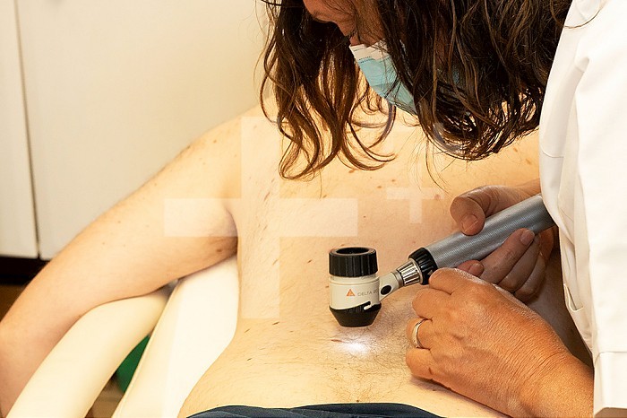 Checking moles on a patient. For the dermatologist, the problem is to distinguish a benign mole from a melanoma, the development of which can be fatal.