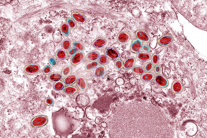 Variola virus (poxviruses are large viruses of 300/200/100 nm. They are pathogenic for humans such as smallpox and vaccinia viruses as well as animal viruses that infect humans such as viruses monkeypox, cowpox, milker´s nodule, pustular dermatitis in sheep Transmission electron microscopy.