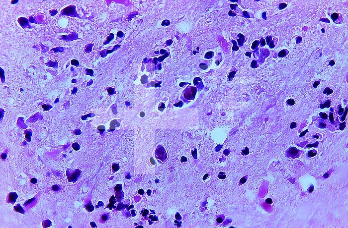 This photomicrograph of a sample of mouse brain tissue revealed the presence of some of the histopathology caused by an amoebic Acanthamoeba polyphaga infection. Note that there were a number of cysts of A. polyphaga in the field of vision. CDC/Dr George Healy 1973