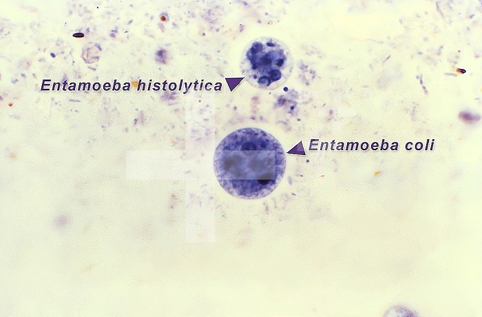 This photomicrograph of an iron-hematoxylin-stained specimen, revealed the presence of two amoebic organisms in their cystic stages of their development. In this focal plane, the smaller Entamoeba histolytica cyst (top), contained four nuclei, and two bluntly-tipped chromatoid bodies, while six nuclei could be detected in the larger Entamoeba coli cyst (bottom), which also contained two chromatoid bodies as well. CDC/ Dr. Mae Melvin 1977