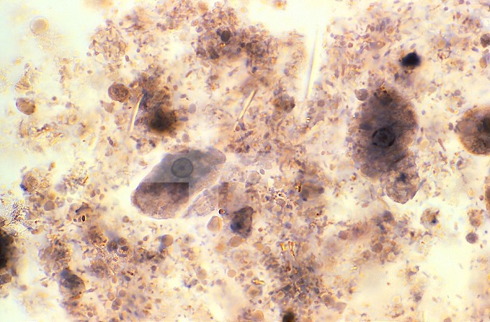 This photomicrograph of an iron hematoxylin stained specimen revealed the presence of a number of amoeboid trophozoites, Entamoeba histolytica. CDC/Dr Mae Melvin 1977