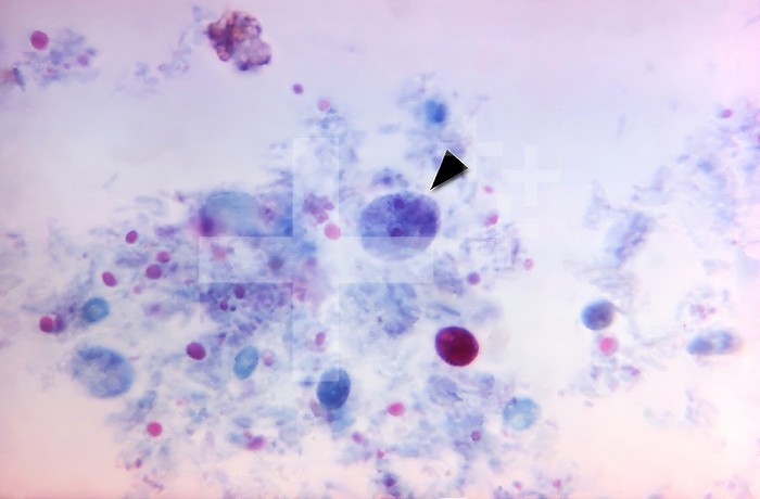This photomicrograph revealed the presence of a binucleate parasitic trophozoite of Dientamoeba fragilis, stained with trichrome, in this specimen (arrowhead). CDC 1970
