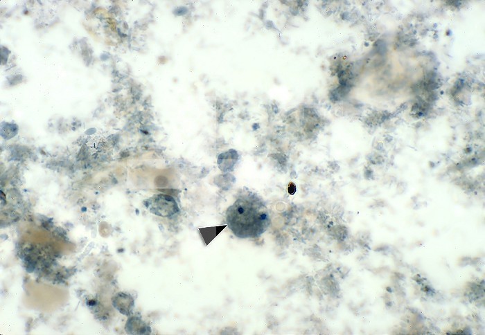 This photomicrograph revealed a good example of a binucleate parasitic trophozoite, Dientamoeba fragilis, stained with iron and hematoxylin, in this specimen (arrowhead). CDC/Dr Mae Melvin 1977