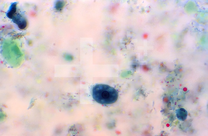 This trichrome-stained photomicrograph revealed a parasitic Entamoeba histolytica trophozoite that contained a single round nucleus in which you can see peripherally located chromatin and a centrally located karyosome. Also note the presence of numbers of vacuoles in the cytoplasm of the organisms. CDC/Dr Mae Melvin 1977