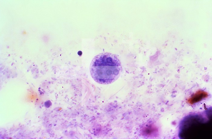 This photomicrograph of an iron-hematoxylin stained specimen revealed the presence of a mature Entamoeba coli cyst, which contained five visible nuclei, each with its eccentrically located karyosome and peripherally located chromatin. CDC/Dr Mae Melvin 1977
