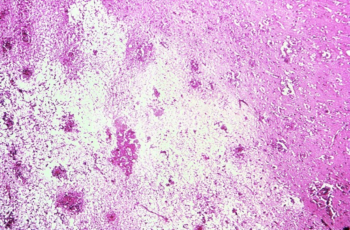 Magnified 500X, this photomicrograph depicted some of the histopathologic changes associated with an infection found in a brain tissue specimen, due to the presence of free-living amoebae of the genus, Acanthamoeba . CDC/ Dr. George R. Healy 1971