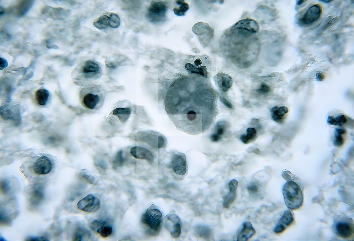 This photomicrograph of a brain tissue specimen depicts the cytoarchitectural changes associated with a free-living amebic infection, which may have been caused by either a Naegleria fowleri , or an Acanthamoeba sp. organism. These organisms were found in the brain of a Japanese Prisoner of war in the 1950´s, before we knew about the free living amebae, and how they attack the brain. CDC/ Dr. Martin D. Hicklin 1964
