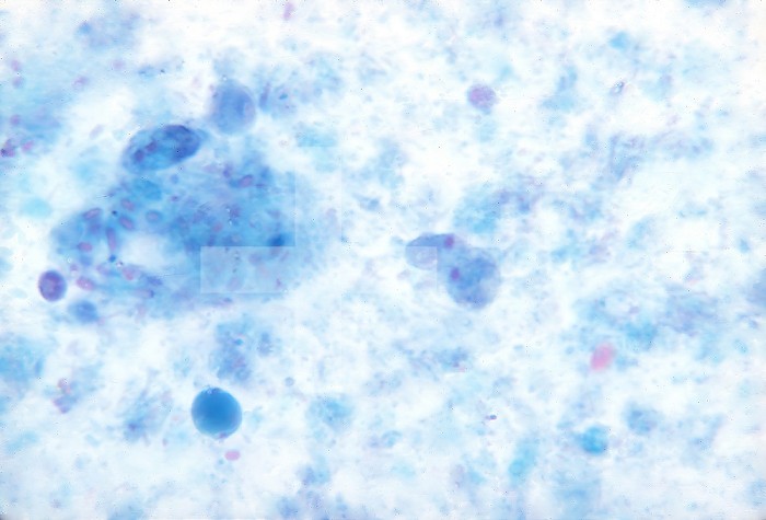 This photomicrograph revealed the presence of trichrome-stained parasitic Dientamoeba fragilis trophozoites in this specimen. CDC 1970