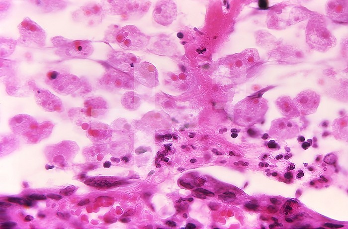 Under a magnification of 500X, this photomicrograph of a sample of intestinal mucosa, revealed the histopathologic changes associated with an amebiasis infection due to the parasitic organism, Entamoeba histolytica . In this view, youre able to see numerous E. histolytica trophozoites, many of which contain ingested by red blood cells (RBCs), which these amoeba engulfed through a process known as erythrophagocytosis. CDC 1970